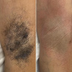 Acne Facial | 60 min - Skincare