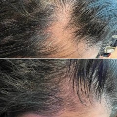 Dermaplaning Facial | 45 min - Skincare